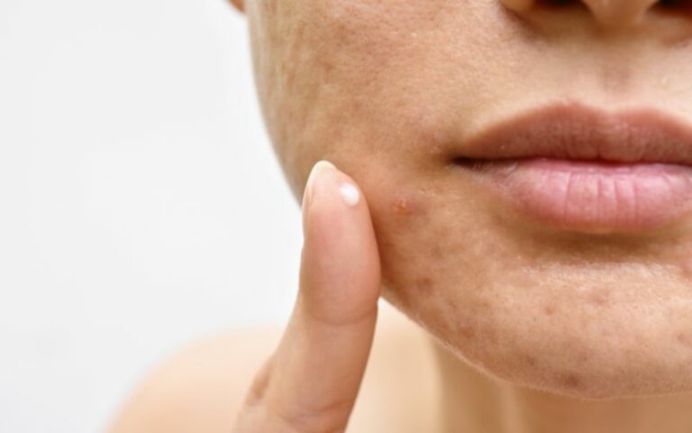 Faccia gonfia da cortisone