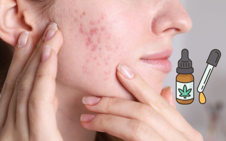 Come trattare l’acne con il CBD